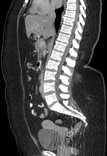 Challenges Of Pelvic Imaging In Obese Women Radiographics