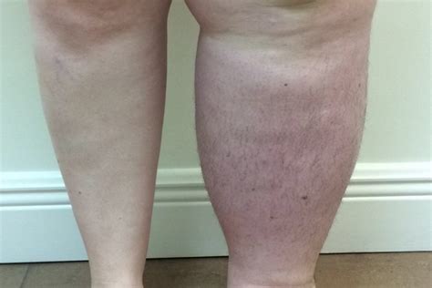Lymphedema Dermatology Conditions And Treatments