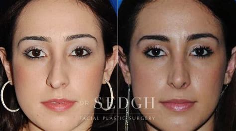 Los Angeles Deviated Septum Surgery West Hollywood Septoplasty Repair