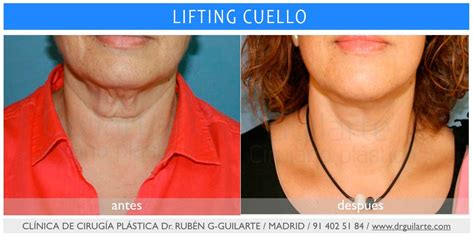 Lifting Facial Cervical Cuello Rostro Precios Madrid