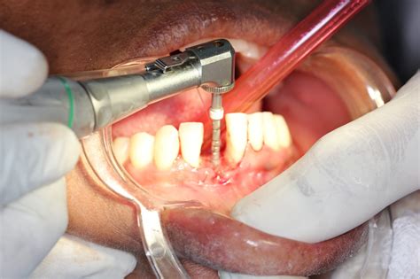 This miracle occurs by substituting the heat cure material with light cure resin for the tray. Understanding Prosthodontics - Tagore Dental College ...