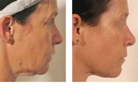 Radio Frequency Skin Tightening The Me Clinic
