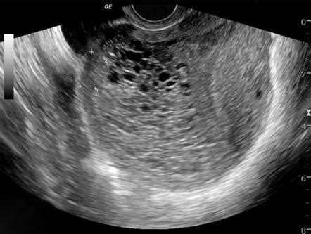 Molar Pregnancy Radiology Reference Article Radiopaedia Org