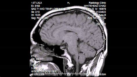 Pituitary Tumor Ct Scan Images Ct Scan Machine
