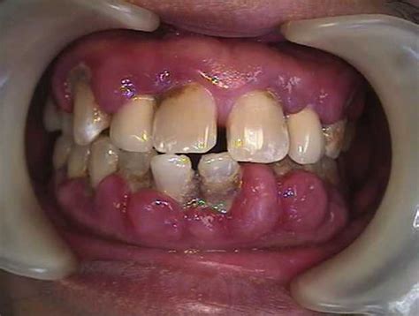 Calcium Channel Blockers Can Cause Gum Problems
