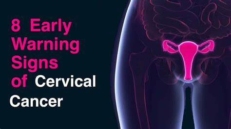Cervical Cancer Symptoms Symptoms And Early Warning Signs Of Cancer My XXX Hot Girl