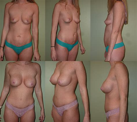 Breast Augmentation With Asymmetrical Implants Before After