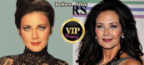 Lynda Carter Plastic Surgery Before And After Photos