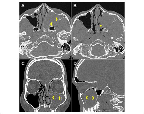 Computed Tomography Ct Images Axial View A And B Coronal View