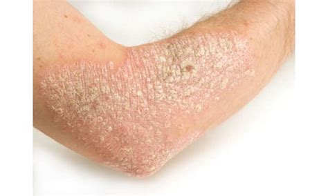 Fatigue Occurs In 50 Percent With Chronic Plaque Psoriasis