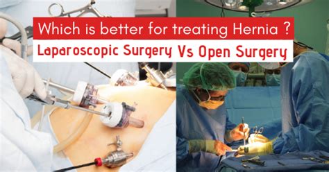 Which Is Better For Hernia Open Vs Laparoscopic Surgery