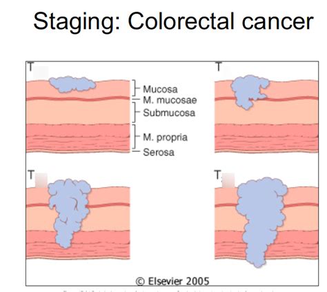 Staging Colorectal Cancer Diagram Quizlet