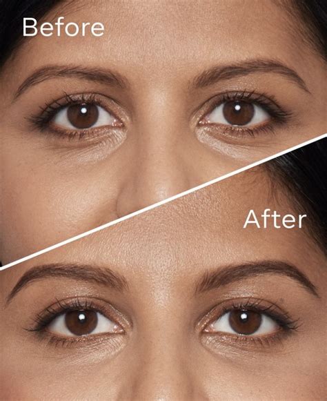 How To Fix A Hollow Eye Area Vedas Medical Spa