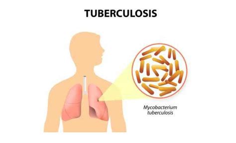 Mengenal Penyakit Tbc Gejala Dan Cara Penularannya Lenterajatengcom