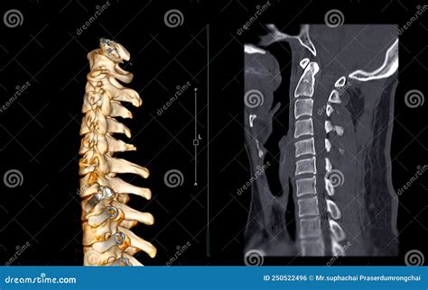 Ct Scan Of Cervical Spine C Spine Stock Illustration Illustration Of