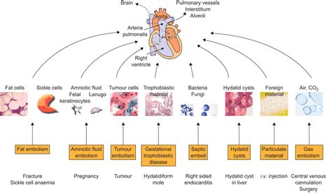 Embolus Types Cardiovascular Medbullets Step 1