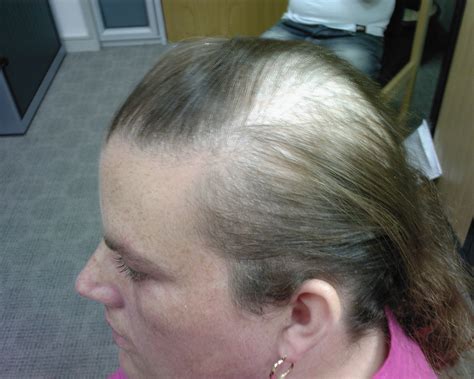 The Hair Loss Centre A Severe Case Of Female Hair Loss And Psoriasis