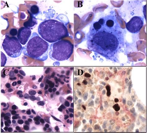 Wright Giemsa‐stained Bone Marrow Aspirate Smears Performed At
