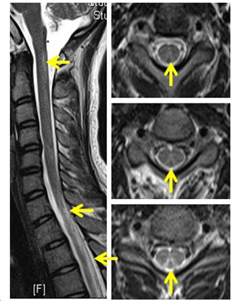 Abnormal Cervical Spine Mri