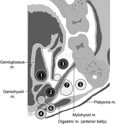 Dermoid Cysts Of The Lateral Floor Of The Mouth A Comprehensive