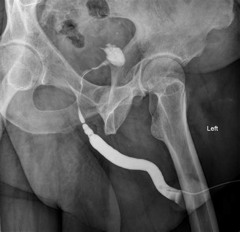 Bulbar Urethral Stricture Image Radiopaedia Org