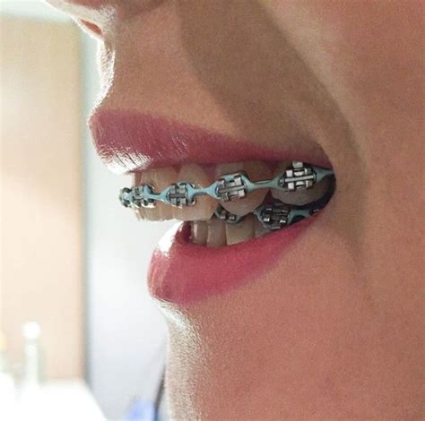 Braces Braceface Metalbraces Girlswithbraces Powerchain Overbite Brackets Dentales