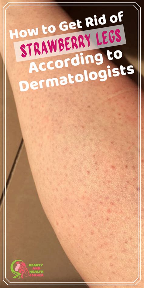 How To Get Rid Of Strawberry Legs According To Dermatologists In 2020