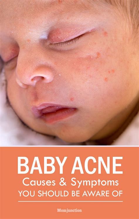 Baby Acne What Causes Them And How You Can Prevent Baby Acne Baby