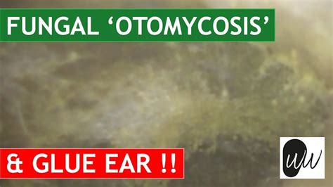 Most Challenging Otomycosis Fungal Ear Infection Removal From Ear With