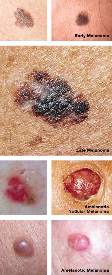 Melanoma Is The Most Aggressive Of The Common Skin Cancers
