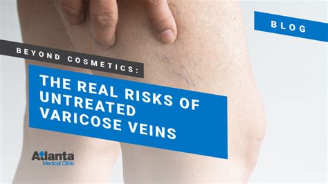 Not Just Cosmetics The Real Dangers Of Untreated Varicose Veins