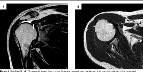 Figure 1 From Magnetic Resonance Imaging Of Rotator Cuff Free Nude