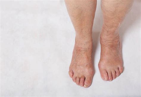 How To Stop Legs From Swelling On A Long Flight Swollen Legs Swollen