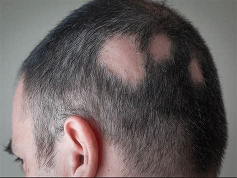Top 48 Image Dermatologist For Hair Loss Vn