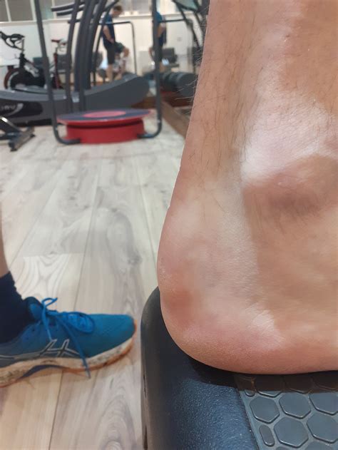 Sore Lump On The Back Of Your Heel