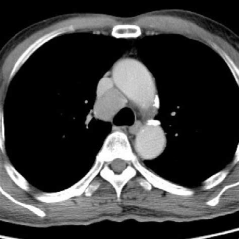 Computed Tomography Scan Showing Mediastinal Lymph Node Adenopathy