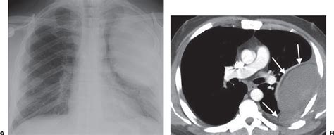 Pleura Chest Wall And Diaphragm Radiology Key