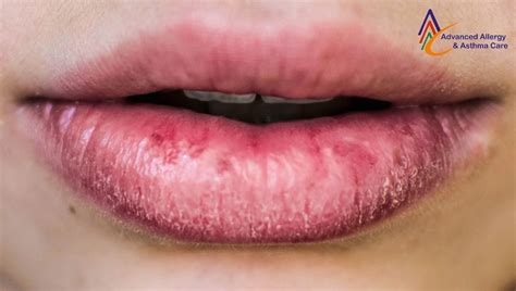 Swollen Urticaria Lips Causes And Treatment By Advanced Allergy And