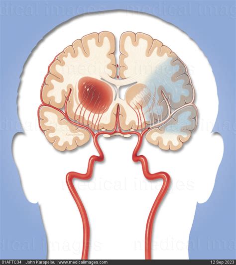 Stock Image Illustration Of A Brain Showing A Hemorrhagic Stroke Leftand An Ischemic Stroke