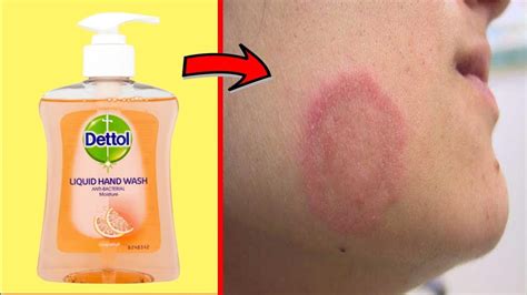 How To Cure Fungal Ringworm Naturally Fast Fast Ringworm Treatment At