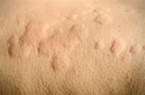 ¿por Qué Tengo Picazón En La Piel In 2020 Chronic Hives Itchy Skin
