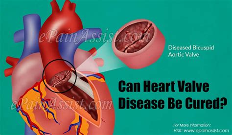 Can Heart Valve Disease Be Cured