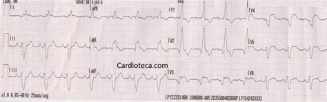 Curso Ecg Infarto Agudo De Miocardio En Paciente Que Tiene Un Bloqueo