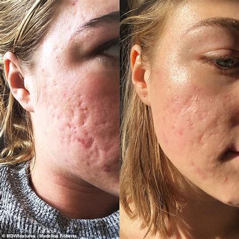 Woman With Cystic Acne Feared She Was Unlovable Due To
