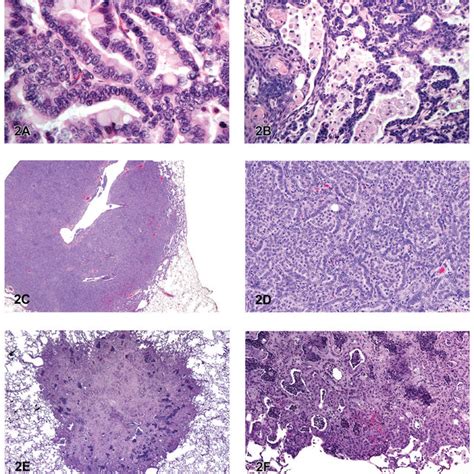 Cystic Keratinizing Epithelioma And Squamous Cell Carcinoma A Cystic