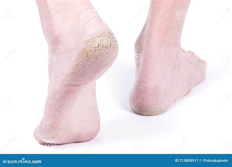 Diabetic Foot Feet Cracked Heels Legs Of A Person Stock Image Image