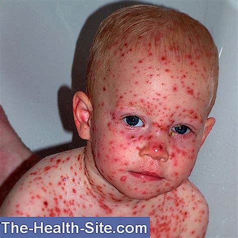 Chickenpox Infection Symptoms Dangers 💊 Scientific Practical Medical