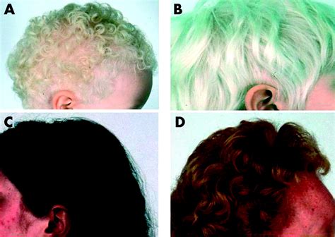 P Gene Mutations In Patients With Oculocutaneous Albinism And Findings