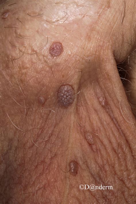 Virusul Hpv Asimptomatic Revista Galenus Hpv Warts Genital My XXX Hot