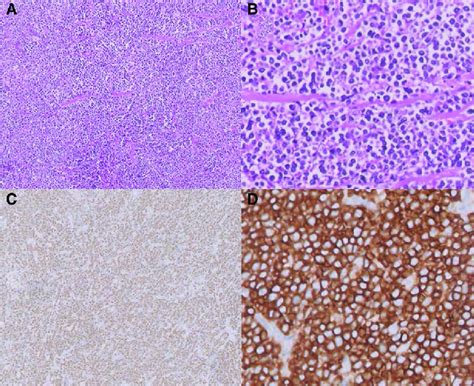 A Atypical Lymphoid Cells At 20× B Atypical Lymphoid Cells At 40×